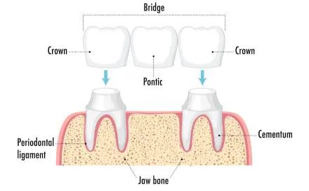 Crowns & Bridges at Bondi Dentistry