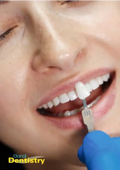 Composite resin restorations at Bondi dentistry.