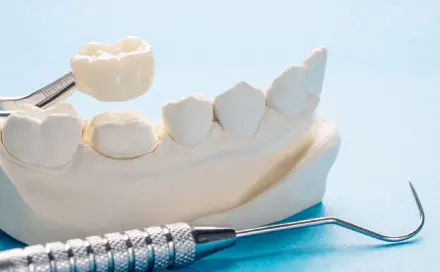 Crowns & Bridges at Bondi Dentistry