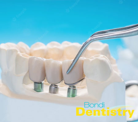 Crowns & Bridges at Bondi Dentistry