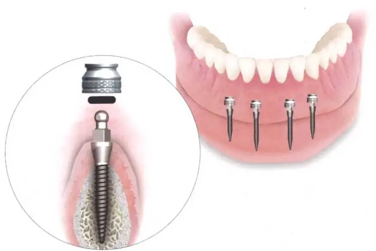 Mini Implants from Bondi Dentistry