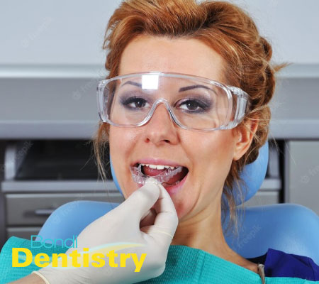 Splints at Bondi Family Dentistry