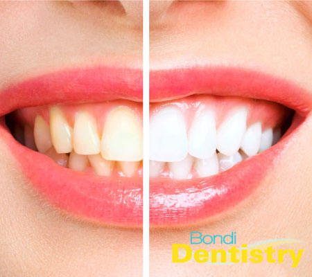 Teeth whitening at Bondi Dentist