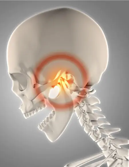 TMJ Disorders and splints at Bondi Dentistry