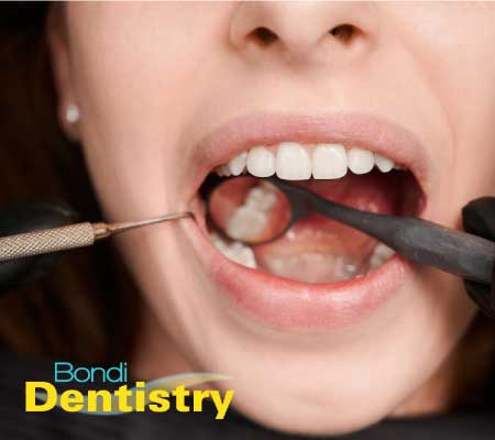 Tooth fillings at Bondi Dentistry