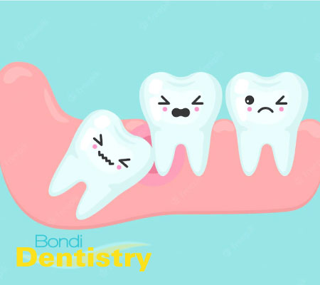 Wisdom teeth services at Bondi Dentistry